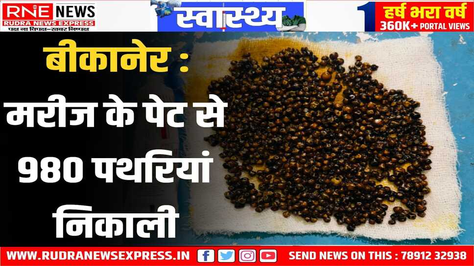 PBM Hospital में मरीज के गाल ब्लेडर से 980 पथरियां निकाली