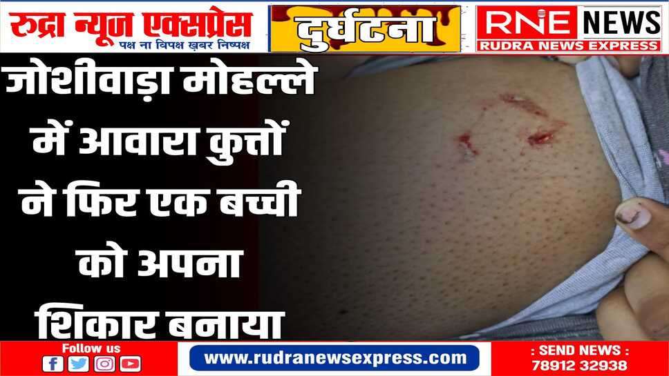 BIKANER : आवारा कुत्ते ने बच्ची के पांव और हाथों पर काट खाया