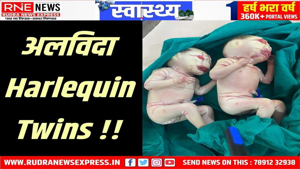 Twin Harlequin Baby नहीं रहे, बस इतनी ही सांसें लेने दुनिया में आए थे ये भाई-बहिन! 