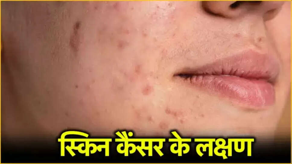 Skin cancer 
