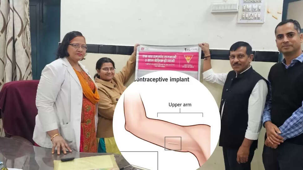 No Pragnancy : बाजू पर पिन लगाओ प्रेग्नेंसी की चिंता से मुक्त हो जाओ, टेबलेट, सर्जरी, कॉपर टी की नहीं पड़ेगी जरूरत 