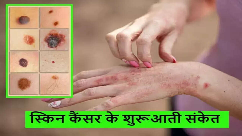 Skin cancer