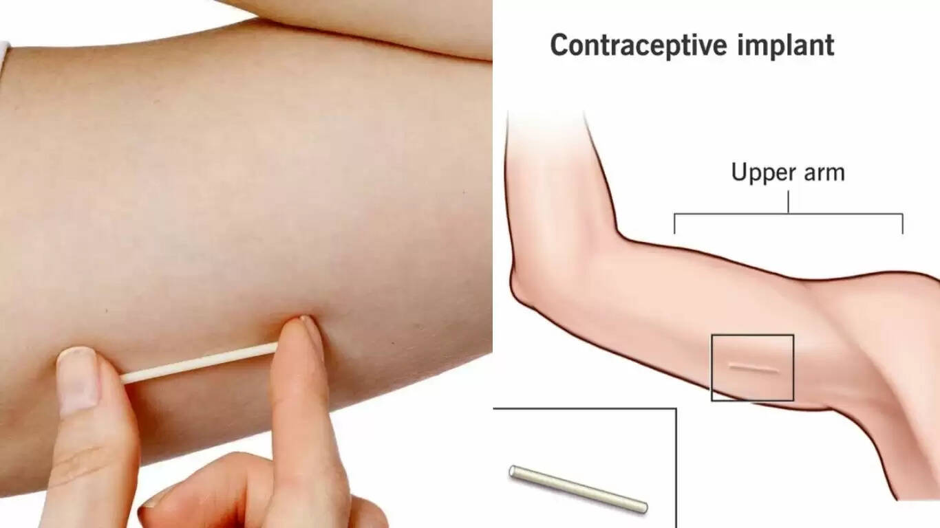 No Pragnancy : बाजू पर पिन लगाओ प्रेग्नेंसी की चिंता से मुक्त हो जाओ, टेबलेट, सर्जरी, कॉपर टी की नहीं पड़ेगी जरूरत 